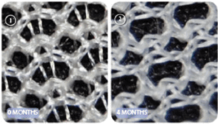 Image: Resorption of TIGR matrix Surgical Mesh over a four-month period (photo courtesy Novus Scientific). Image: Resorption of TIGR matrix Surgical Mesh over a four-month period (photo courtesy Novus Scientific).